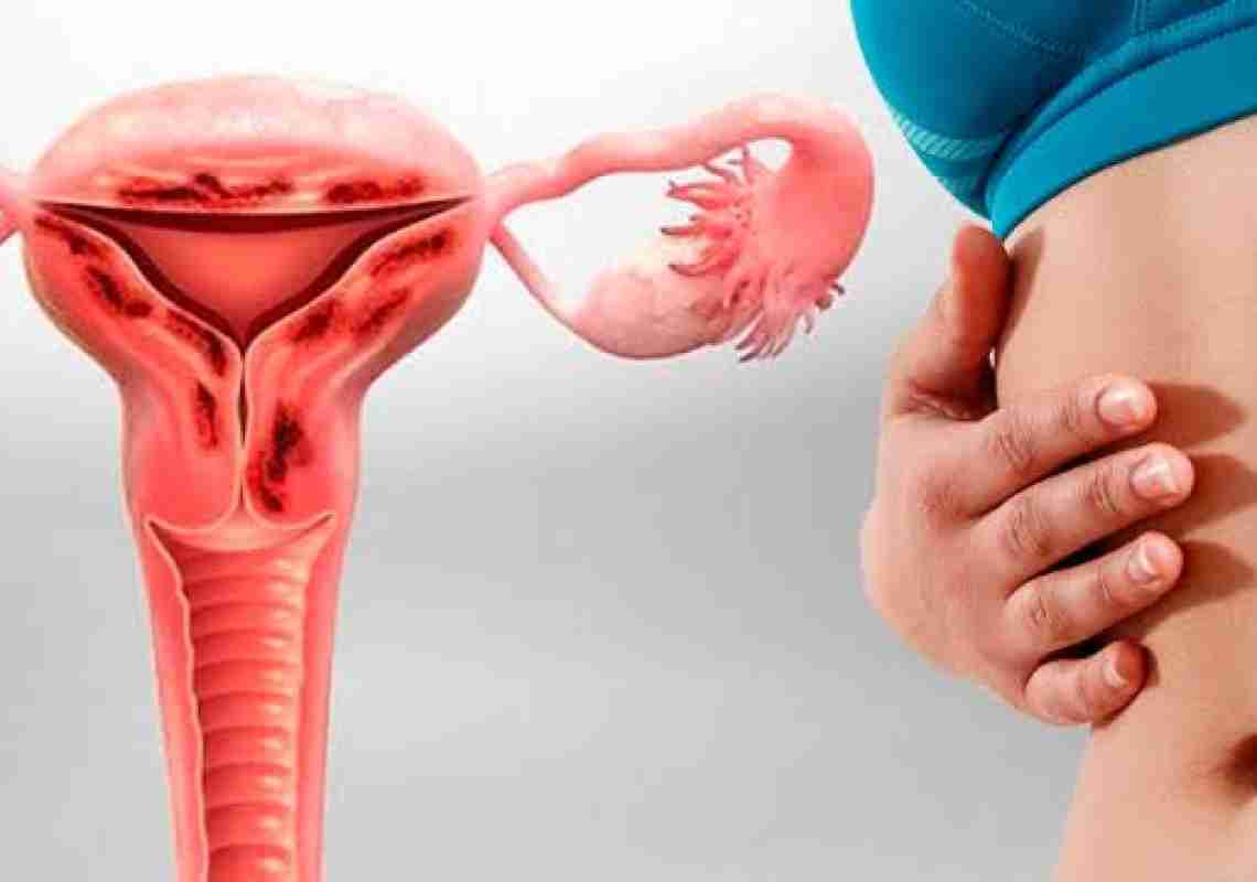 Adenomiose Uterina: compreendendo uma condição desafiadora